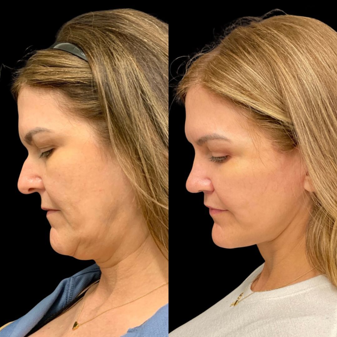 RobbJrMD's tweet image. Jaclyn’s 5-month Robb Refresh update 👀✨

At this stage, swelling has settled, tissues have healed, and what you’re seeing now is the beginning of long-term results — not the final chapter😉