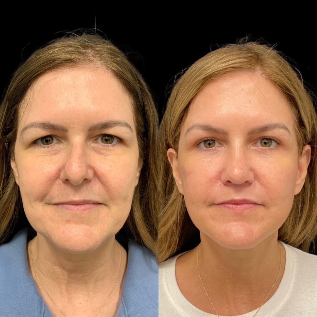 RobbJrMD's tweet image. Jaclyn’s 5-month Robb Refresh update 👀✨

At this stage, swelling has settled, tissues have healed, and what you’re seeing now is the beginning of long-term results — not the final chapter😉