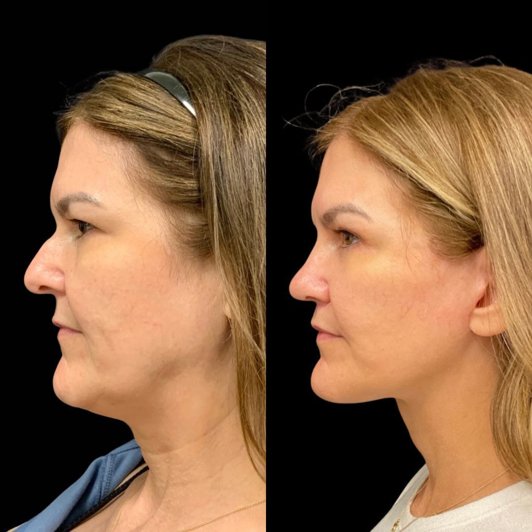 RobbJrMD's tweet image. Jaclyn’s 5-month Robb Refresh update 👀✨

At this stage, swelling has settled, tissues have healed, and what you’re seeing now is the beginning of long-term results — not the final chapter😉