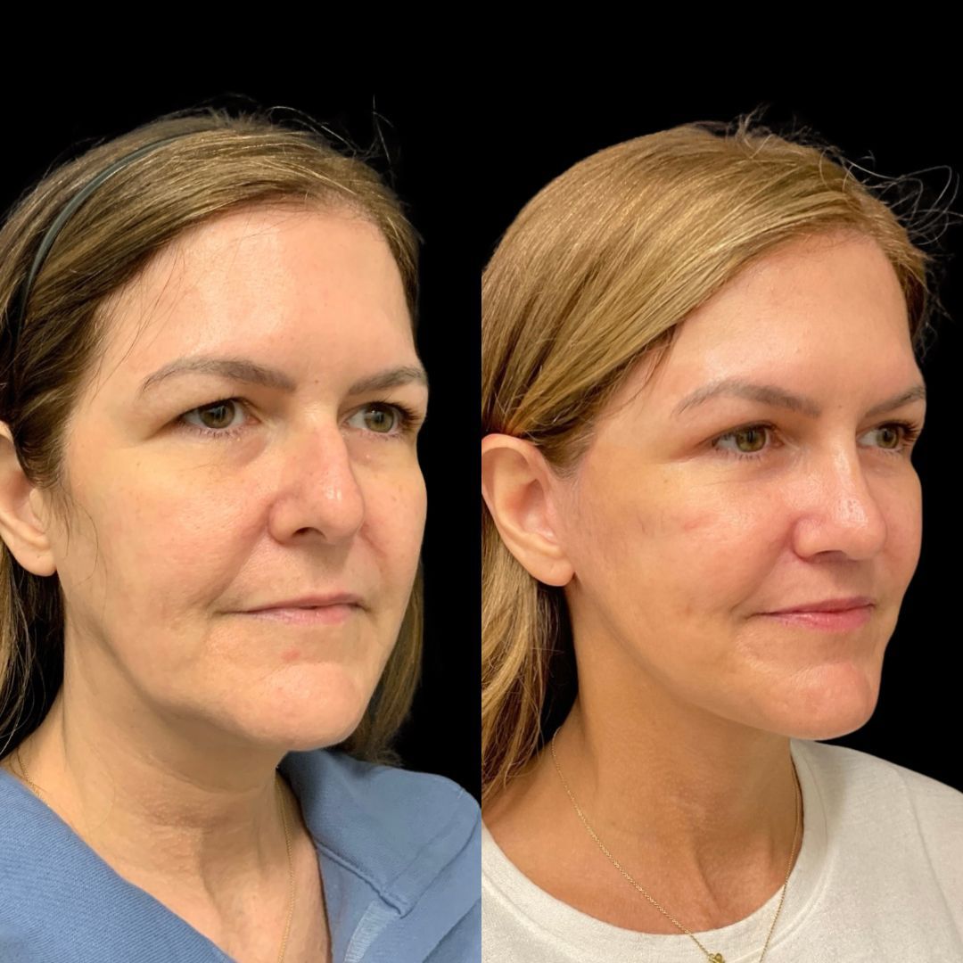 RobbJrMD's tweet image. Jaclyn’s 5-month Robb Refresh update 👀✨

At this stage, swelling has settled, tissues have healed, and what you’re seeing now is the beginning of long-term results — not the final chapter😉