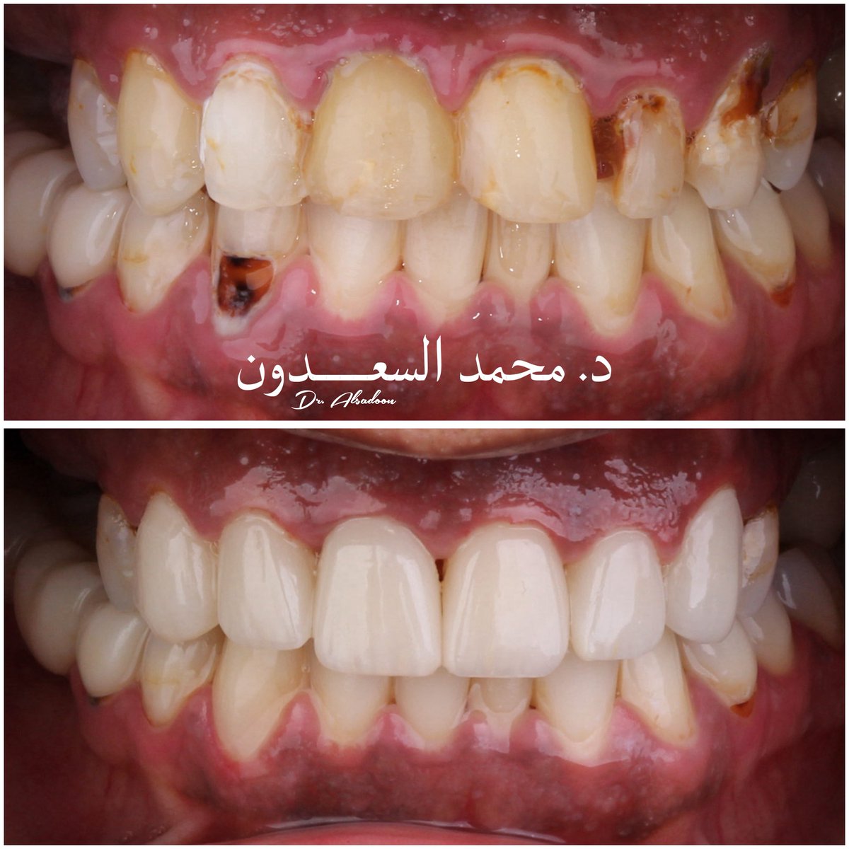 مكونات النجاح في هذه الخطة العلاجية:
1. التثقيف الصحي.
2. معالجة المشاكل الأساسية:
-تنظيف اللثة
-علاج التسوسات
-إعادة علاج العصب
-وضع الأوتاد
3. التجميل:
-إزالة التصبغات
-تبييض الأسنان
-عمل حشوات تجميلية للأسنان
-تصميم الإبتسامة فينير وتركيبات السيراميك التجميلية للأسنان