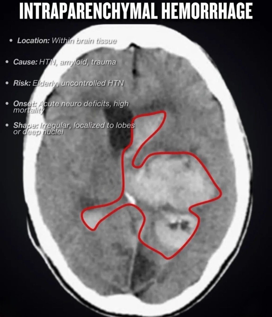 🧠𝗛𝗘𝗠𝗢𝗥𝗥𝗔𝗚𝗜𝗔 𝗜𝗡𝗧𝗥𝗔𝗖𝗥𝗔𝗡𝗘𝗔𝗟🩸
⬇️⬇️⬇️⬇️ 

🩸 𝙎𝙪𝙗𝙙𝙪𝙧𝙖𝙡: venosa · 🌙 semilunar · cruza suturas · inicio lento
🩸 𝙀𝙥𝙞𝙙𝙪𝙧𝙖𝙡: arterial (MMA) · 🥽 biconvexa · NO cruza suturas · “intervalo lúcido”
🩸 𝙎𝙪𝙗𝙖𝙧𝙖𝙘𝙣𝙤𝙞𝙙𝙚𝙖: LCR · ⭐ en