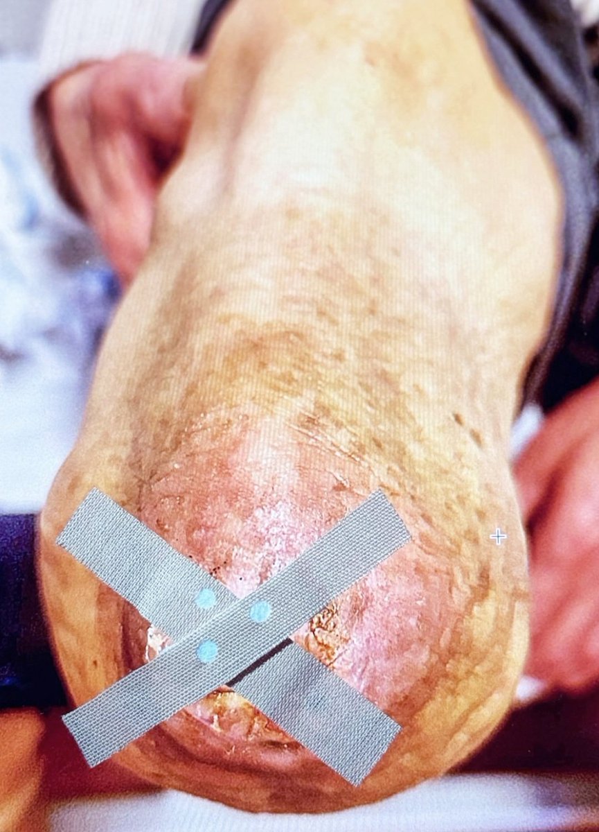 Mijn patiënt heeft diabetes. Een aandoening die in Nederland zelden tot amputatie hoeft te leiden. Mits je op tijd medicijnen krijgt. Mits je je voeten kunt wassen. Mits je ergens kunt zitten om je wond te verzorgen. Mits iemand meekijkt.