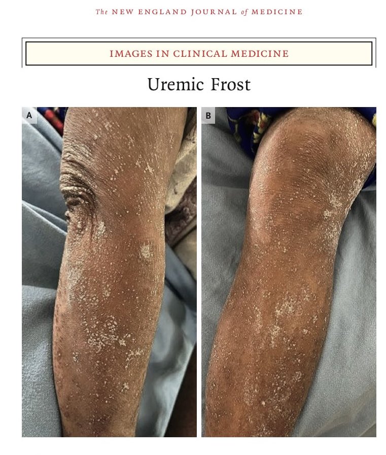 🧊 Uremic frost (escarcha urémica) ❄️

📌 La escarcha urémica:
•Es una manifestación rara
•Aparece cuando el BUN > 200 mg/dL
•Ocurre cuando el sudor cargado de urea se evapora, dejando cristales visibles en la piel 

📍 Caso clínico

👩🏼‍🦳 Mujer de 52 años, antecedente de