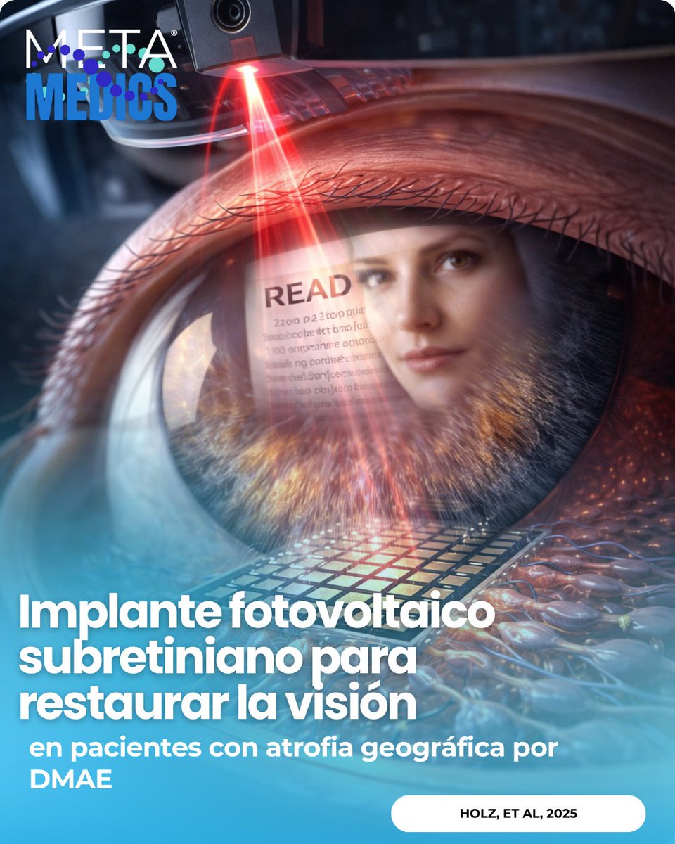 Metamedicsmx's tweet image. Un microimplante subretinal fotovoltaico (PRIMA) + gafas con infrarrojo mejoró visión en atrofia geográfica por DMAE: 26/32 (81%) lograron ≥0.2 logMAR a 12 meses. Fuente: NEJM. DOI: 10.1056/NEJMoa2501396