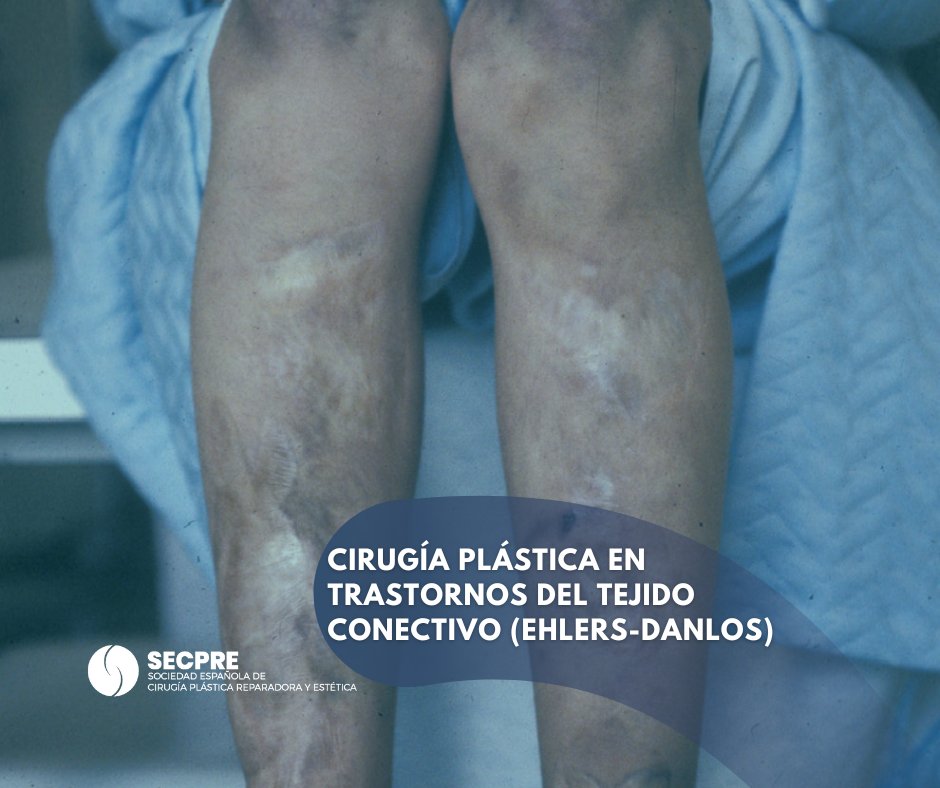 SECPREorg's tweet photo. 🧵 En pacientes con Ehlers-Danlos, la cirugía plástica requiere técnica adaptada: suturas reforzadas, cierre por planos y seguimiento estrecho debido a la fragilidad del tejido y la cicatrización delicada.
La seguridad siempre es la prioridad.
#EhlersDanlos #SECPRE https://t.co/fJg8vuoTCa