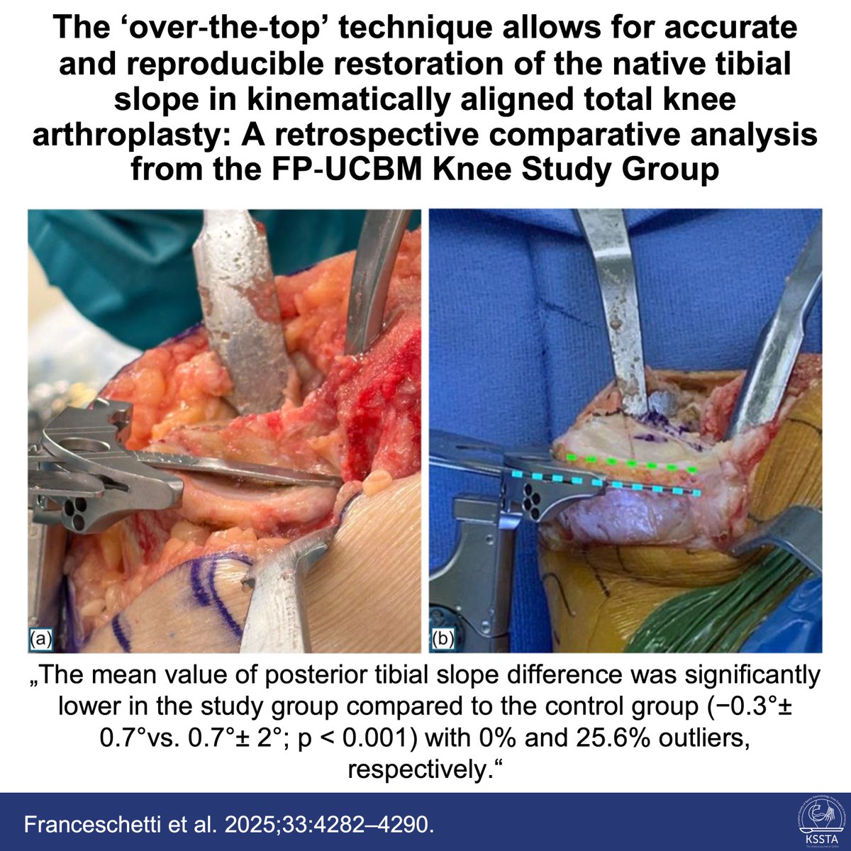 KSSTA's tweet image. This new KSSTA paper introduces a novel method of setting the posterior tibial slope in kinematically aligned TKA.
 
#knee #TKA #arthroplasty #slope #KSSTA
 
Read here: doi.org/10.1002/ksa.12…