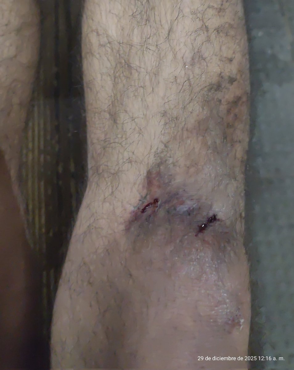 Último choque de 2025 por qué no pienso volver a tocar la moto hasta el año que viene.

Vengo por la izquierda, el pelotudo por la derecha y se cruza sin señalizar ni mirar el espejo.

La cantidad de pelotudos que hay con registro es impresionante la verdad.