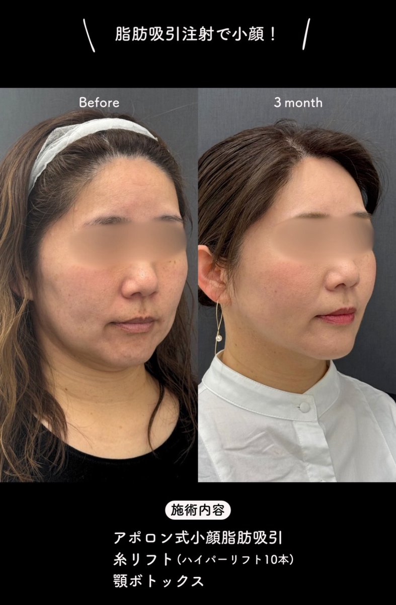 ApollonClinic's tweet photo. アポロン式の脂肪吸引は圧迫の必要がなくてダウンタイム最小限✨💉 https://t.co/DMbq6U0t2q