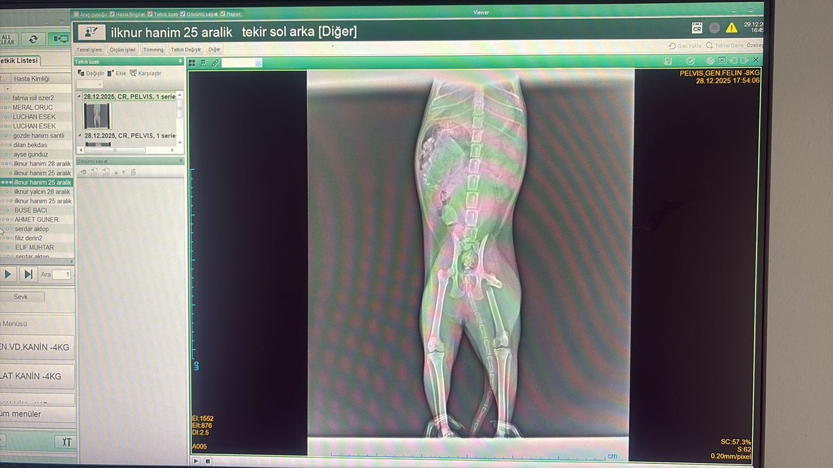 Arkadaşlar lütfen paylaşır mısınız.
Yılbaşı tatili araya girmeden yarın ameliyat olması gerekiyor. Ayrıca kırığı daha fazla bekletmemeliyim