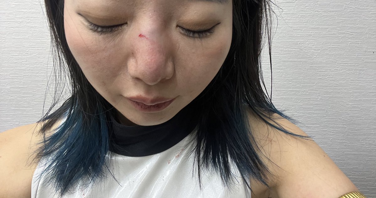 鼻骨折疑惑です！！曲がりました！🫠🫠🫠🫠
多分大丈夫だと願います！！！
マジ年末深夜救急とか怖すぎて行けない💸💸💸💸💸www

全然元気です！あざした！！
Have a nice DIE🖤🖤