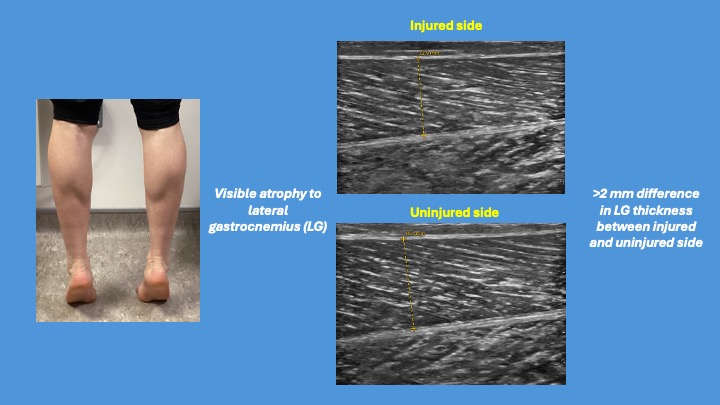 The lateral gastrocnemius (LG) is often the biggest victim in Achilles tendinopathy, with greater atrophy and loss of neural drive - something I commonly see in my work, and highlighted by Crouzier (2019) &amp; Fernandes (2023 &amp; 2025).

#AchillesTendinopathy #LateralGastrocnemius

🧵