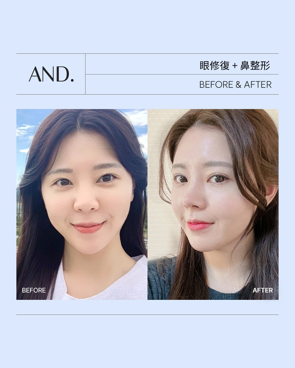 双眼皮手术| Astrid 整形外科, image size:960x1200