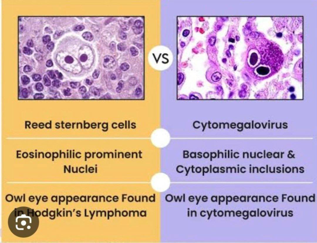 للطلاب المقبلين على اختبار الهيئة 
الفرق بين Reed-Sternberg cells و Cytomegalovirus (CMV):
Reed-Sternberg cells
هذي خلايا سرطانية مميزة تظهر في لمفوما هودجكن.
وتبان كأنهاًعين بومة 👀
Cytomegalovirus (CMV)
هذا فيروس يسبب عدوى.
برضه شكلها يشبه عين البومة، بس السبب هنا عدوى فيروسية