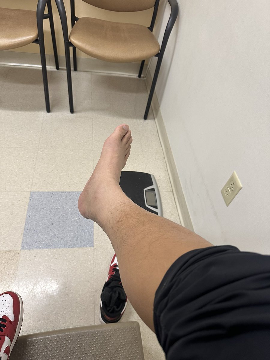 TeamLiwap's tweet image. 3 month post op follow up… all is well!!! 🙌