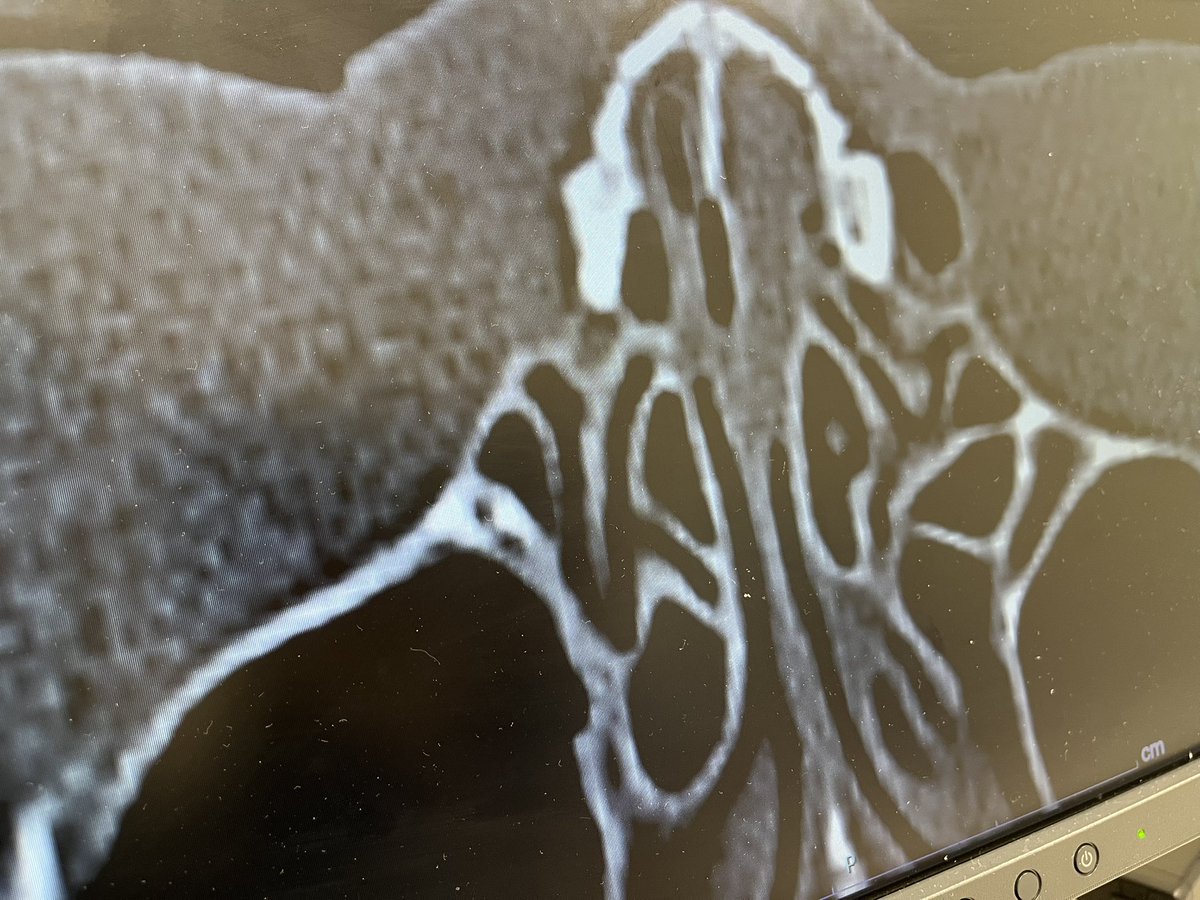結果！鼻  2箇所折れてました🫠🫠

が、年末は試合します🥺！！

すこし落ち着いたら手術のためお休み貰うかもしれません🙇休む時間作れるかな😭