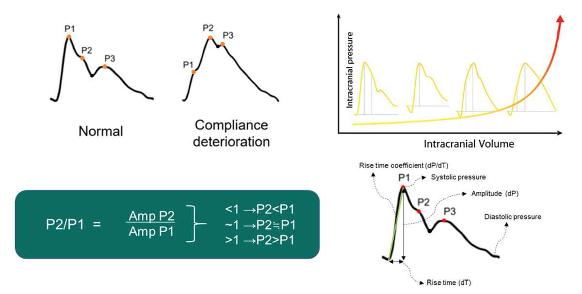 Personalized treatment approaches in neurocritical care

CCR Journal Watch 
criticalcarereviews.com/latest-evidenc…