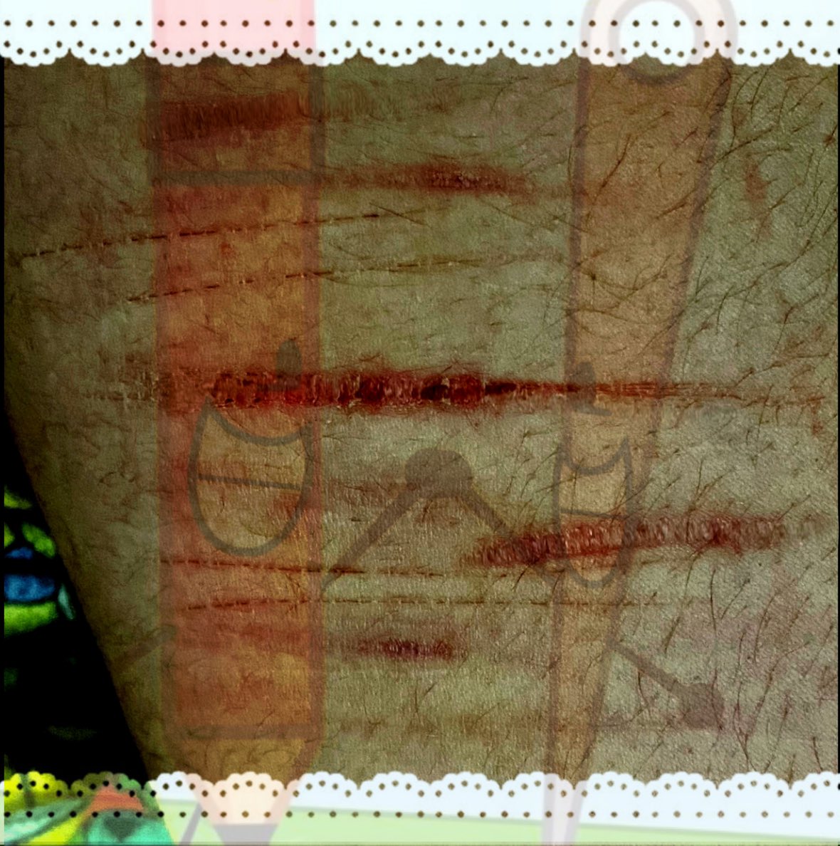 MEPHOJISMYFAV's tweet photo. !! CUTS (Styro and catscratch) AND HEALING PROGRESS PHOTOS!!
(ALL EDITED!!) :DDDDD
#shtwt
#slittwt
#selfharm
#selfmutilation
4 tags ew I'm so attention hungry https://t.co/XC8vr8ikJJ