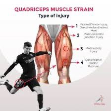 digitupbro's tweet image. 28/12/25 פציעת עלי מוחמד
קרע בשריר הארבע ראשי.
🔸עלי נפצע באימון ונשלח להדמיה שהדגימה קרע בשריר הארבע ראשי.
לא נמסרה דרגת החומרה של הפציעה ומיקומו על פני השריר, אך מהערכת זמן החזרה לאימונים (כ-6 שב׳) ניתן להסיק שמדובר בקרע מהותי בדרגת חומרה גבוהה.
🔸פציעת ארבע ראשי היא כמעט תמיד…