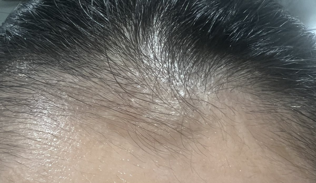 FbYh9i's tweet photo. 【ヘアライン植毛2ヶ月＋1週間】
本当に植毛してない状態になってて、ただの暗黒期なのか生着しなかったんじゃないか不安になってきました... https://t.co/L5u8TDDyj4
