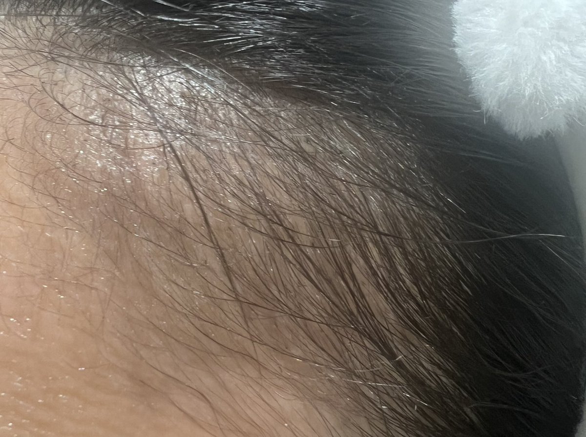 FbYh9i's tweet photo. 【ヘアライン植毛2ヶ月＋1週間】
本当に植毛してない状態になってて、ただの暗黒期なのか生着しなかったんじゃないか不安になってきました... https://t.co/L5u8TDDyj4