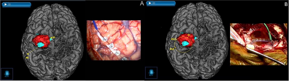 IFCN and its Clinical Neurophysiology journals tweet media