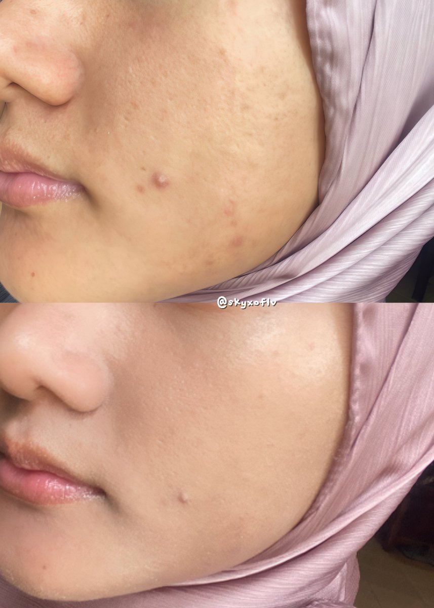 This is an underrated local tinted sunscreen, but just look at the results!😭💗

The Product:                     The Result: