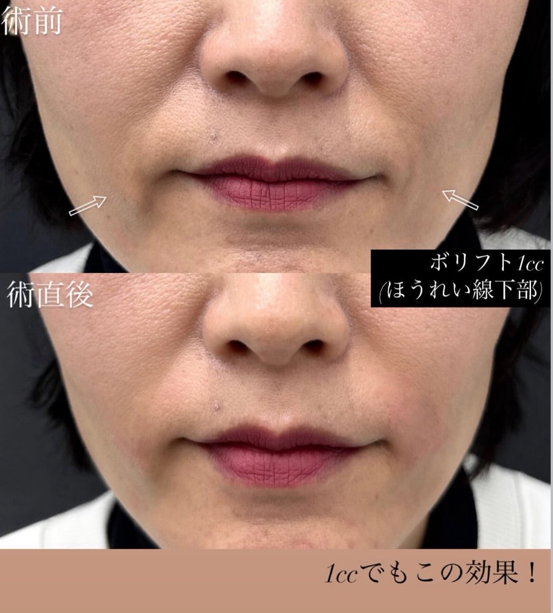 ApollonClinic's tweet photo. 【ヒアルロン酸注射（注入）】
ひとりひとりの骨格や皮膚の状態を診察したうえで「どうなりたいか」を丁寧にヒアリング👂
あなただけのカスタマイズ注入をご提案いたします✨ https://t.co/UmTNXMQYxo