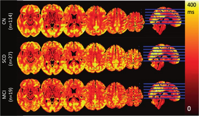 thmonk_pf's tweet image. 脳のBBB水交換時間は認知症超早期で低下

multi-echo ASLで160名(CN/SCD/MCI)のBBB水交換時間(Tex)/CBF/ATTを測定

Texは年齢/性差補正後もSCD段階で既にCNより有意に低下(-9.5%)しCBF低下（MCI段階で出現）に先行

OA

#BBB 
#ASL 
#papers 
sciencedirect.com/science/articl…