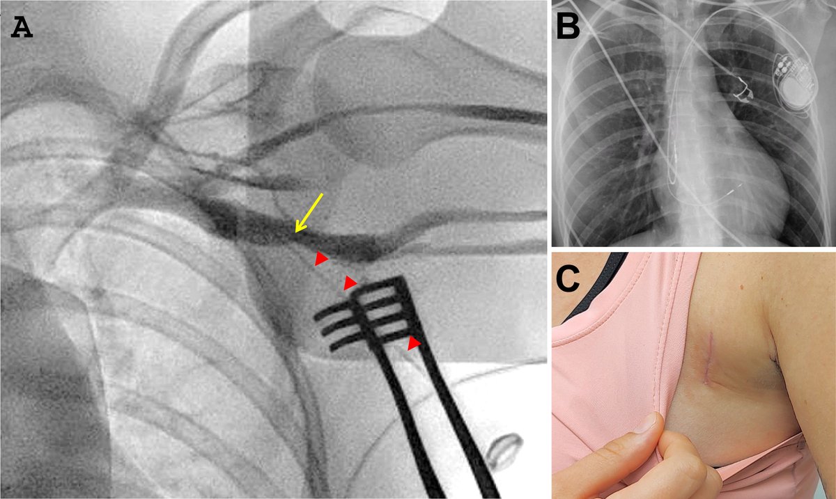 Heart Rhythm Case Reports tweet media