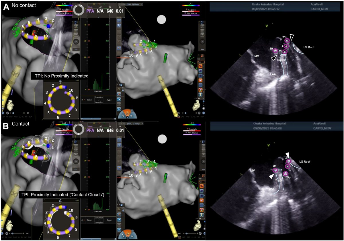 HRS_CaseReports's tweet photo. Visualization of a novel tissue proximity indicator on a variable-loop pulsed field ablation catheter with intracardiac echocardiography
@tkdragnet 
https://t.co/AHd4us3fhM https://t.co/QpNOPeCSMG