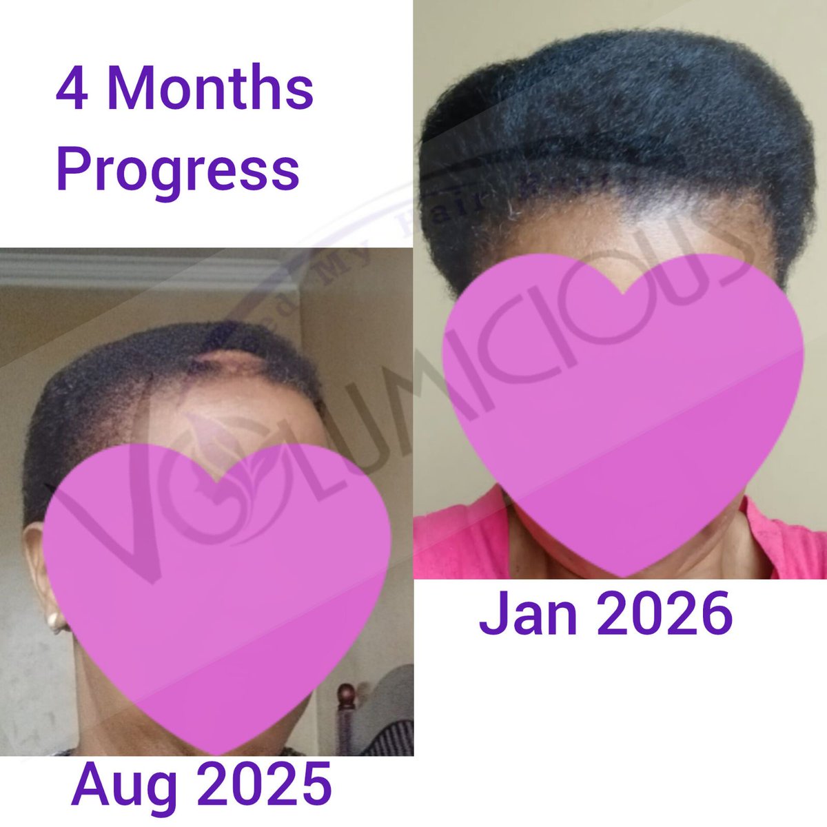 There's Hope with VOLUMICIOUS to those struggling with Alopecia 💜

It's never too late to start your Hair journey today

Recommended Combo: Grow and Restore

Available on our Online Shop volumicious.co.za and <a href="/TAKEALOT/">takealot</a>

#TransformwithVOLUMICIOUS