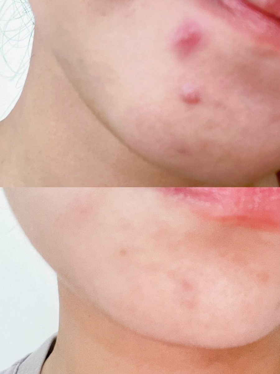 rukkumto's tweet photo. มอยส์ลดสิวที่เราเลือกใช้ช่วงสิวบุก ยกให้แบรนด์ LA ROCHE-POSAY Effaclar Duo+M ตัวนี้ เพราะหมอแนะนำให้ใช้แถมมีงานวิจัยรองรับ มี PHYLOBIOMA ช่วยคุมความมัน ลดการเกิดสิว ลดรอยสิว เป็นมอยส์ที่ทำมาเพื่อคนเป็นสิว ผิวมันโดยเฉพาะ เราใช้ทาทุกวันเช้า-เย็น สิวขึ้นใหม่ลดลง รอยสิวจางเร็วขึ้น 👍 https://t.co/hU5ZKAfUXo