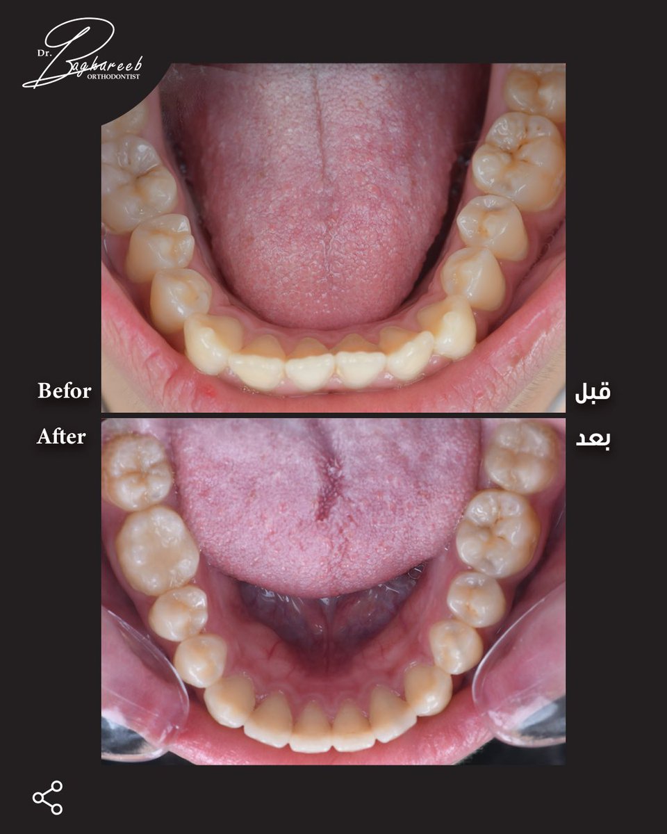 dr_baghareeb's tweet photo. حالة مراجع كان يعاني من سوء اطباق من الدرجة الثانية وبروز في الأسنان مع تزاحم، تم وضع خطة علاجية باستخدام الانفزلاين التقويم الشفاف ووصلنا الى نتيجة جميلة خلال ٧ أشهر فقط 👏🏻👏🏻

A patient case with Class II malocclusion, dental protrusion, and crowding ✨
A customized treatment plan using Invisalign clear aligners was applied,
and we achieved a beautiful result in just 7 months 🦷