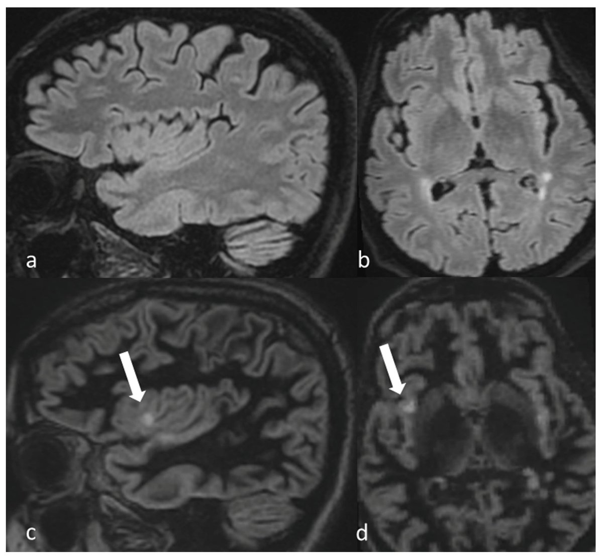 3D-DIR MRI sequences of the MRI (images c/d) are better than FLAIR (images a/b) at visualizing multiple sclerosis plaques near the cortex (arrows) pubmed.ncbi.nlm.nih.gov/41464105/