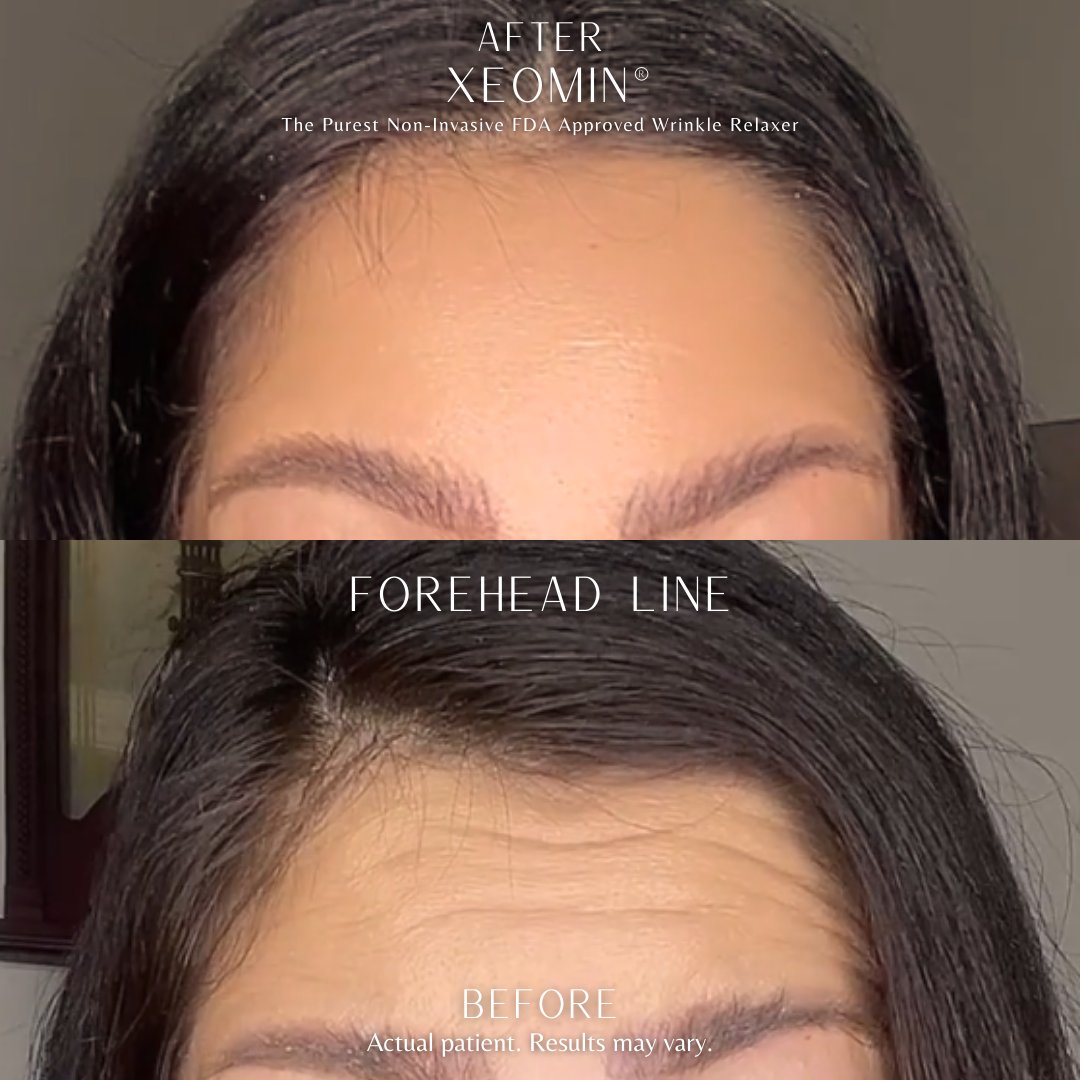 acmedspa's tweet photo. Xeomin today, compliments tomorrow. 😉

Aesthetic Connection Medspa: Generous Medspa in Los Angeles
Click our bio for pricing
#AestheticConnectionMedspa #Medspa #LosAngeles https://t.co/FRtkbidKV6
