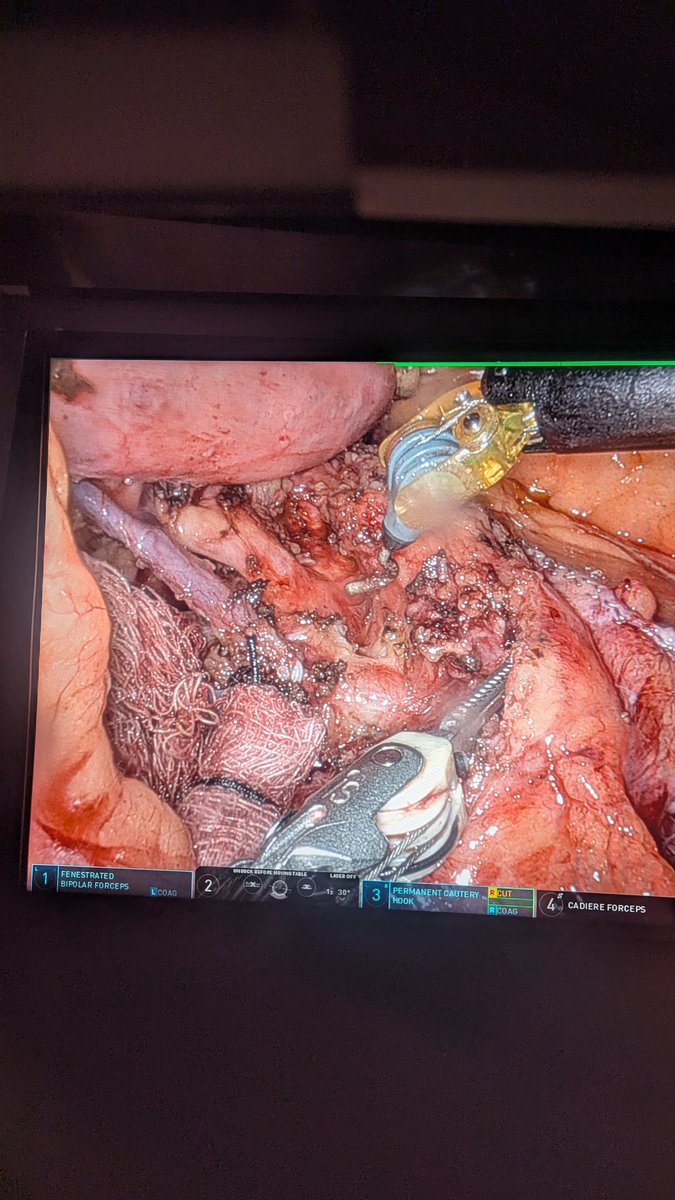SurgOnc_Sam's tweet photo. Robotic assisted hepatic/celiac /Portal lymphadenectomy during DPS for mid body PDAC.
Single firing slow closed(5:01, Nirvana smells like teen Spirit) stapled pancreatic transection. No drain. https://t.co/snrui4wbhi