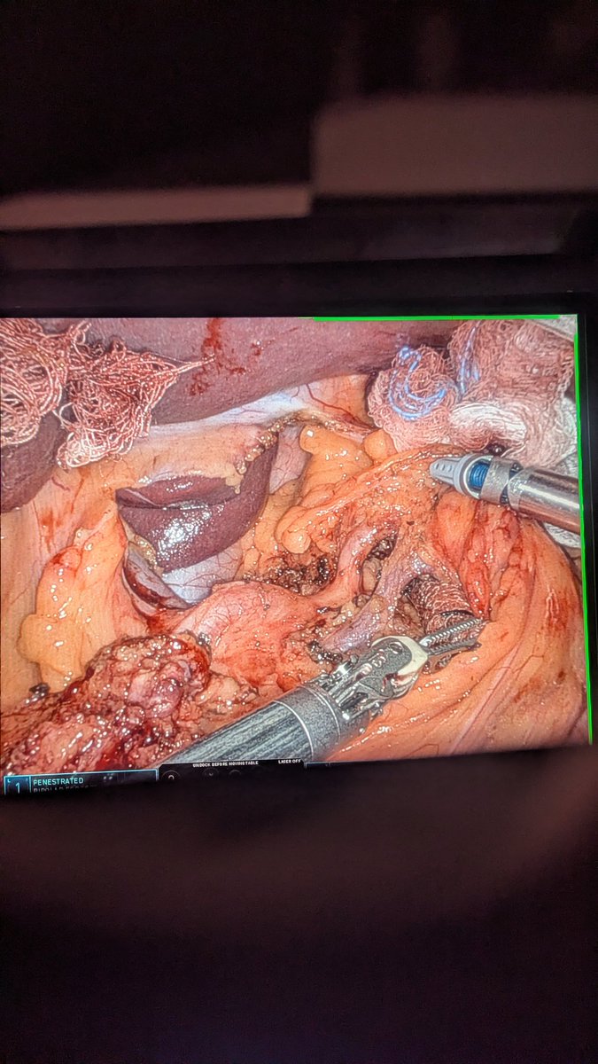 SurgOnc_Sam's tweet photo. Robotic assisted hepatic/celiac /Portal lymphadenectomy during DPS for mid body PDAC.
Single firing slow closed(5:01, Nirvana smells like teen Spirit) stapled pancreatic transection. No drain. https://t.co/snrui4wbhi
