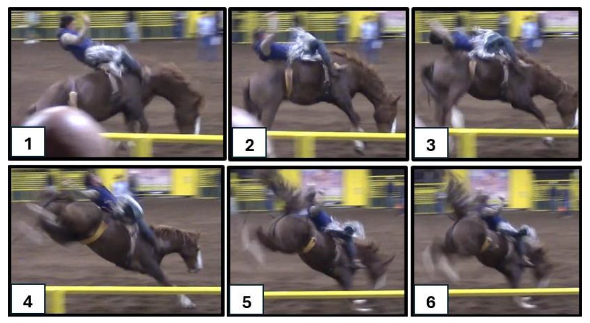 ABMEjournal's tweet photo. Repetitive head impacts threaten long-term brain health, yet some high-risk sports – like rodeo – have largely gone unstudied.

Researchers addressed this gap by measuring head acceleration events in collegiate rodeo athletes competing in Bareback, Saddle Bronc, and Bull Riding using instrumented mouthguards at National Intercollegiate Rodeo Association-sanctioned events.

Across five competitions and 112 rides, they recorded 344 verified head acceleration events, revealing meaningful differences by event type. Bareback produced the most frequent events but lower median accelerations, and across all events the dominant mechanism was whiplash rather than direct head impact.

Even without obvious head contact, rodeo athletes are exposed to substantial head accelerations, underscoring the need to rethink how brain injury risk is assessed beyond traditional collision sports.

𝗥𝗲𝗮𝗱 𝗺𝗼𝗿𝗲: https://t.co/79Ff3j7R3Z

𝗦𝘁𝘂𝗱𝘆: Head Acceleration Events in Collegiate Rodeo Athletes

𝗔𝘂𝘁𝗵𝗼𝗿𝘀: Colton D. Carlson, Jacob J. Miller, @JasonCDorman, @DrVerle, and @ThayneMuncePhD

@usd
@SanfordHealth

𝗦𝘂𝗯𝗺𝗶𝘁 𝘆𝗼𝘂𝗿 𝗺𝗮𝗻𝘂𝘀𝗰𝗿𝗶𝗽𝘁: https://t.co/Gyz8DNnMJO