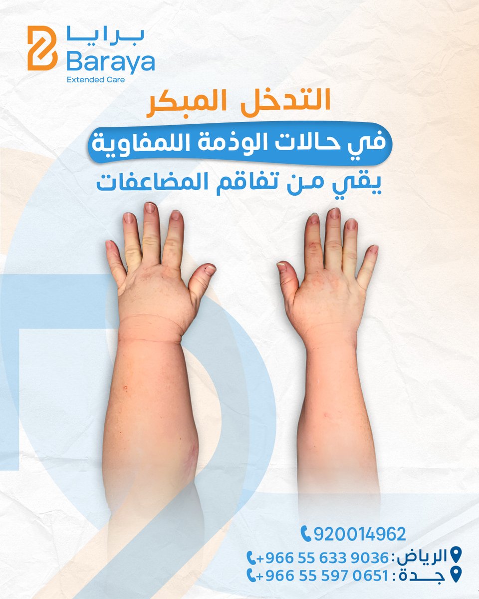 التورّم المستمر ليس مرضًا بحد ذاته، بل عرَض قد يشير إلى مشكلة صحية تحتاج تقييم
وفي بعض الحالات يكون ناتجًا عن خلل أو قصور في الجهاز اللمفاوي

عندما يستمر التورّم ويصاحبه إحساس بالثِقل أو تغيّر في شكل الطرف، فقد يكون مرتبطًا بالوذمة اللمفاوية أو الوذمة الشحمية
الفرق بينهما مهم لأن
