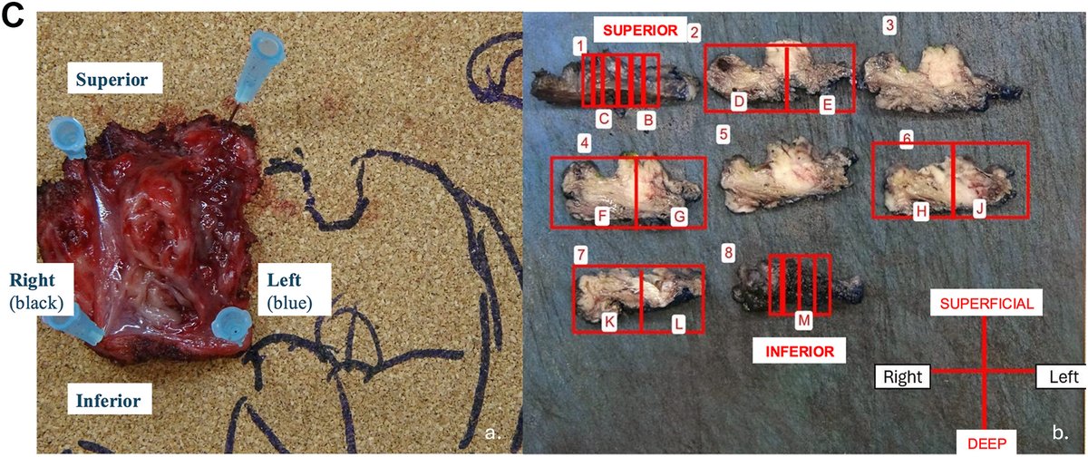 Human_Pathology's tweet image. New in #HumPathol: Making Routine Head and Neck Pathology Easy: From Dissection to Diagnosis. sciencedirect.com/science/articl… #pathology #PathTwitter #PathX #ENTpath