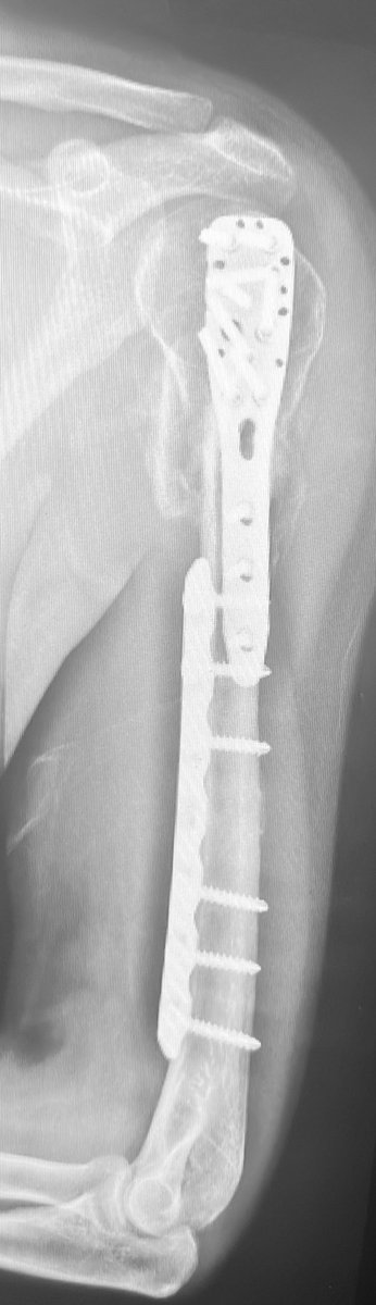 centerofhip's tweet image. Grade 3A open segmental humerus fx in a 20m
Many of you would treat this with a long straight or a twisted PHILOS 
Here I used two implants which makes surgery easier imo. 
Thoughts on this construct #orthotwitter? 
Who would have used a nail?