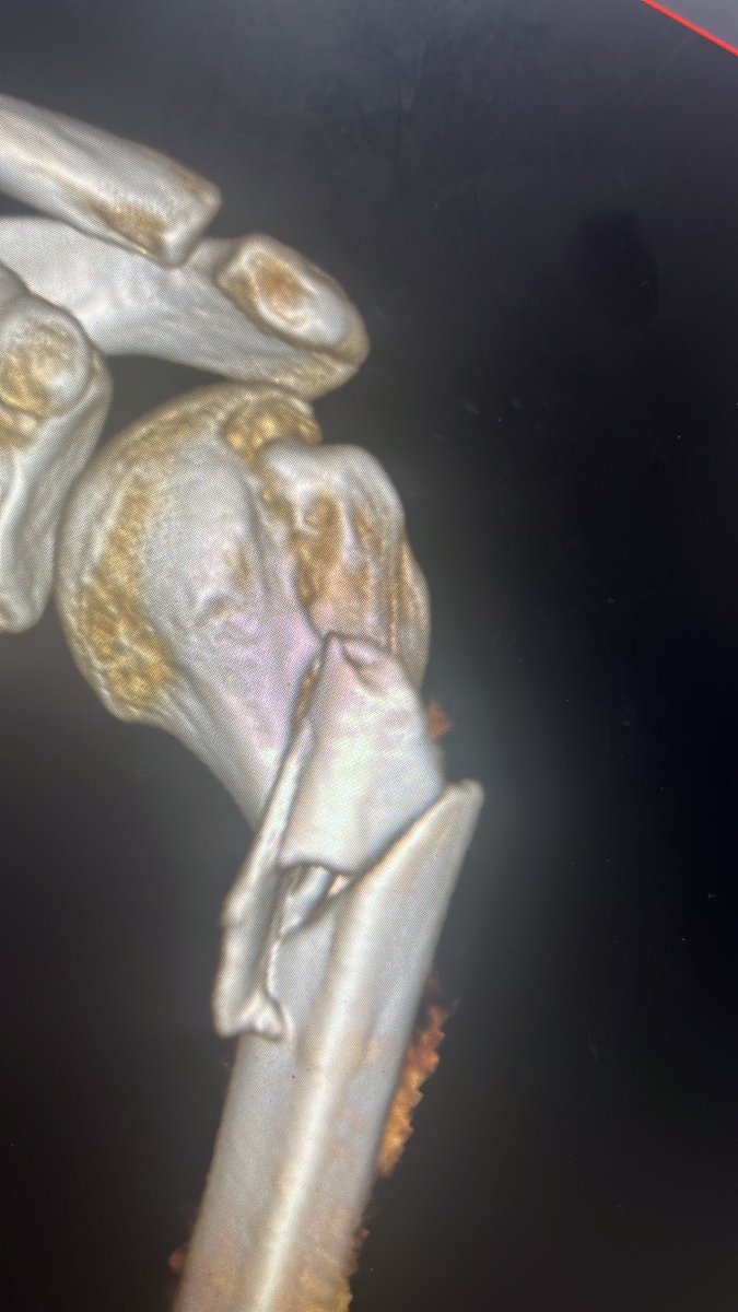 centerofhip's tweet image. Grade 3A open segmental humerus fx in a 20m
Many of you would treat this with a long straight or a twisted PHILOS 
Here I used two implants which makes surgery easier imo. 
Thoughts on this construct #orthotwitter? 
Who would have used a nail?