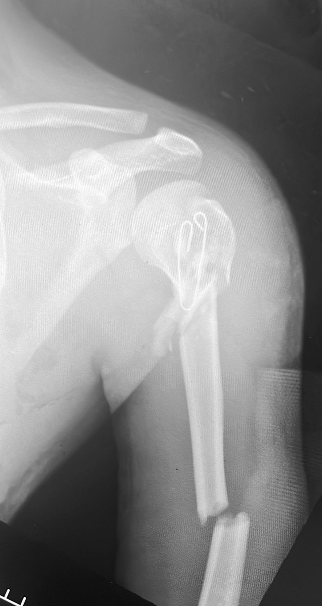 centerofhip's tweet image. Grade 3A open segmental humerus fx in a 20m
Many of you would treat this with a long straight or a twisted PHILOS 
Here I used two implants which makes surgery easier imo. 
Thoughts on this construct #orthotwitter? 
Who would have used a nail?