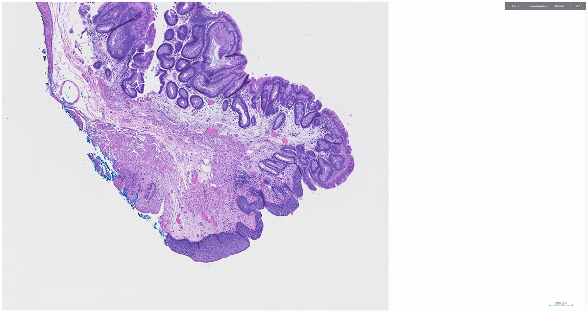 SeanHacking's tweet image. Collision dysplasia: traditional serrated adenoma abutting high‑grade anal intraepithelial neoplasia (AIN 2/3) #pathology #PathTwitter
