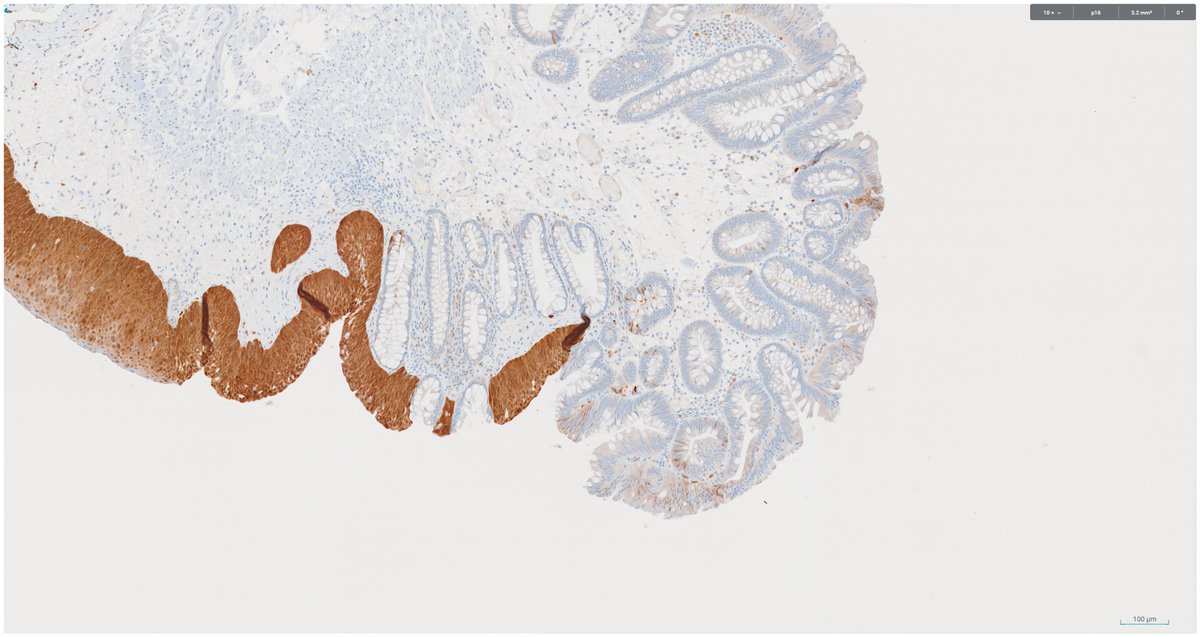 SeanHacking's tweet image. Collision dysplasia: traditional serrated adenoma abutting high‑grade anal intraepithelial neoplasia (AIN 2/3) #pathology #PathTwitter