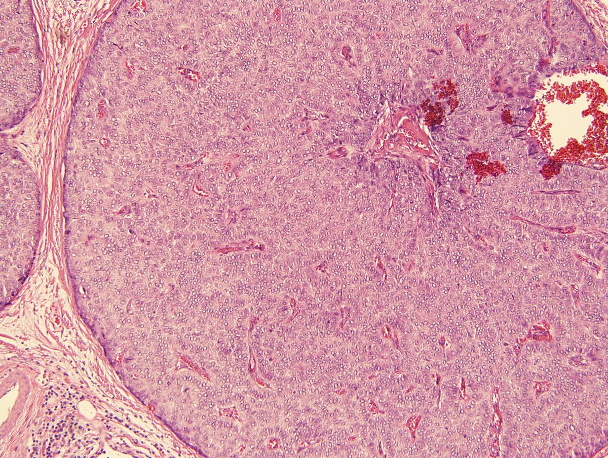 rezaesh58's tweet photo. Nice morphology of solid papillary carcinoma of the breast. SPC is considered invasive if it consists of tumor nodules with an irregular, geographic, or "jigsaw like" pattern and associated desmoplastic reaction. In SPC, myoeps are absent within the fibrovascular cores, but may or may not be present at the periphery. SPC has an indolent clinical course.