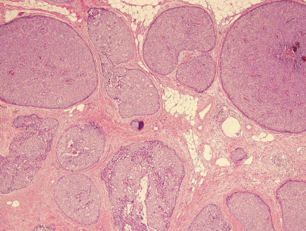 rezaesh58's tweet photo. Nice morphology of solid papillary carcinoma of the breast. SPC is considered invasive if it consists of tumor nodules with an irregular, geographic, or "jigsaw like" pattern and associated desmoplastic reaction. In SPC, myoeps are absent within the fibrovascular cores, but may or may not be present at the periphery. SPC has an indolent clinical course.