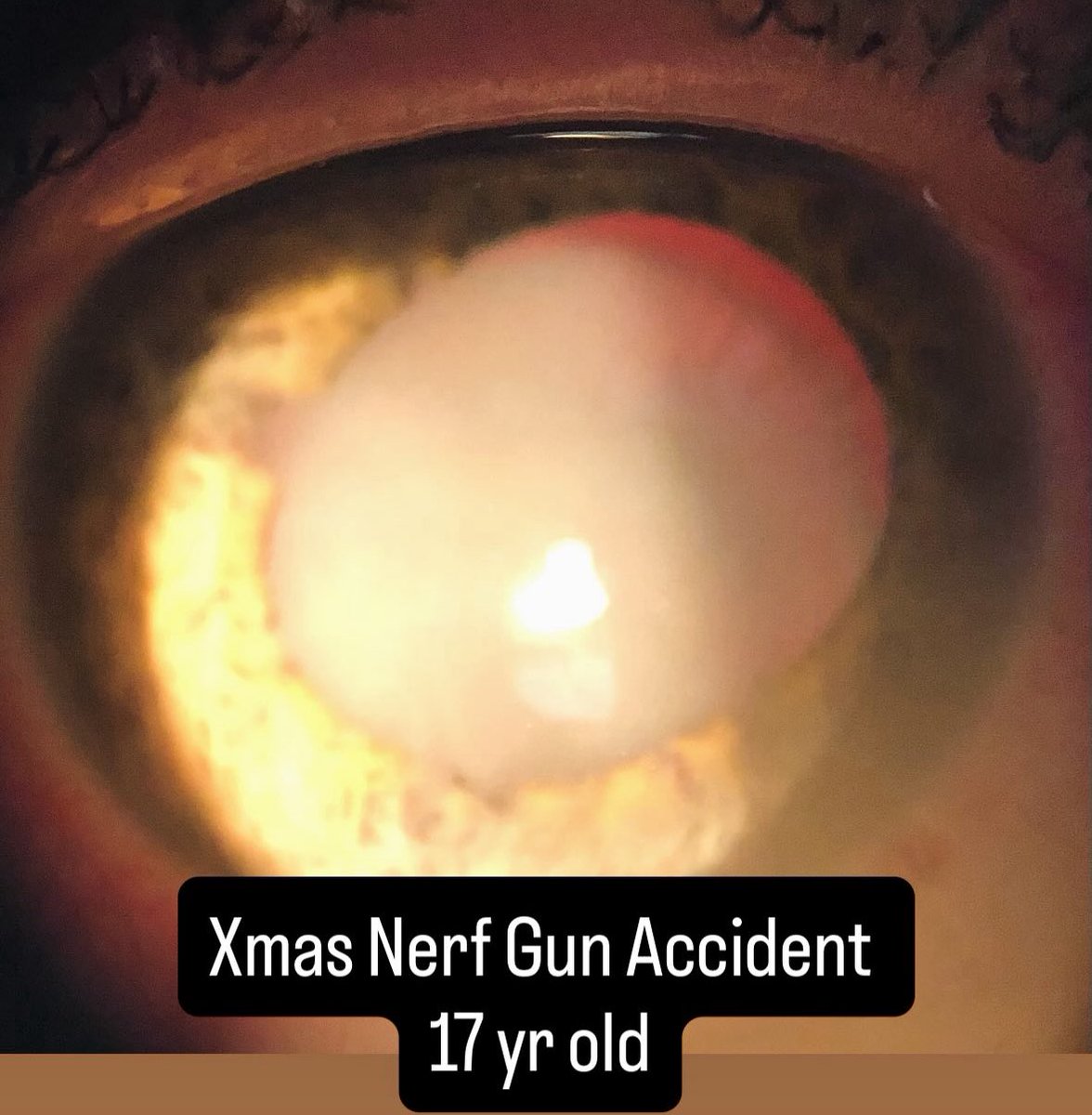 The holidays can be fun but they can also be dangerous. I think this toy should come with goggles.  Hyphema has subsided but a cataract remains. Cataract Surgery in her future.