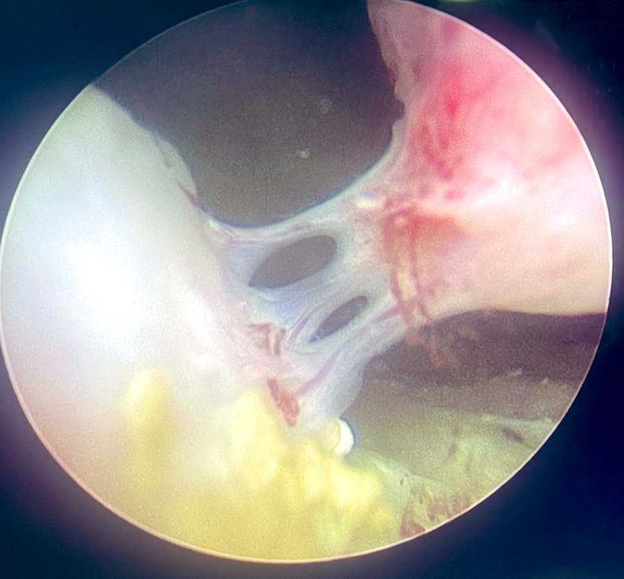 NM_Urology's tweet image. From the desk of Perry Xu, MD (@perryjxu):
-Dr. Xu is seeing more patients post-aquablation with persistent gross hematuria and LUTS. 
-Here are some endoscopic images post-aquablation (6 months to a year ago). Most impressively, one patient had fused vessels across the aqua…